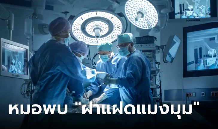 ฝาแฝดแมงมุม