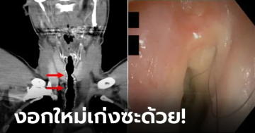 กลุ่มขน ที่ขึ้นในลำคอ